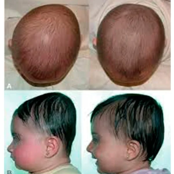 En qué consiste la terapia del casco corrector en recién nacidos? - Clínica  INDISA - Clínica de familia